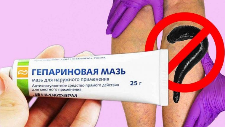 Какими мазями можно лечить варикоз на ногах? - «Красота и Здоровье»