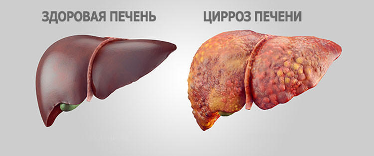 Цирроз печени – болезнь или смертельный приговор? - «Красота и Здоровье»